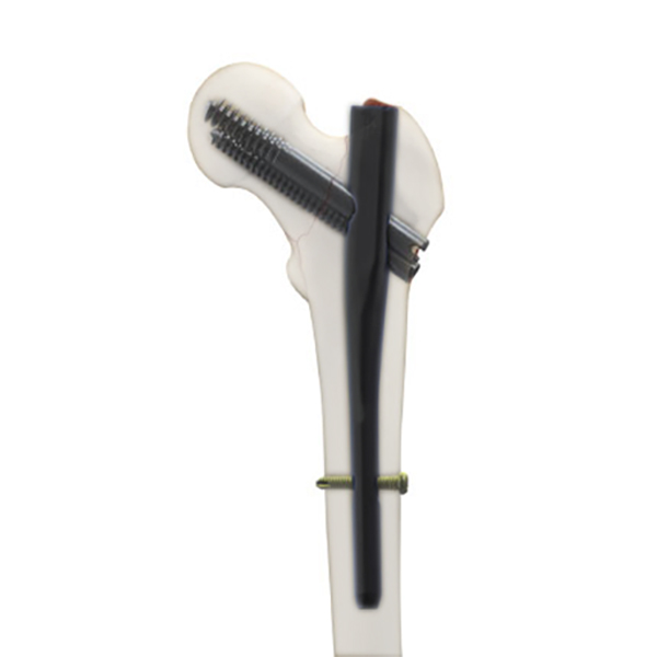 Trigen Intertan Nail