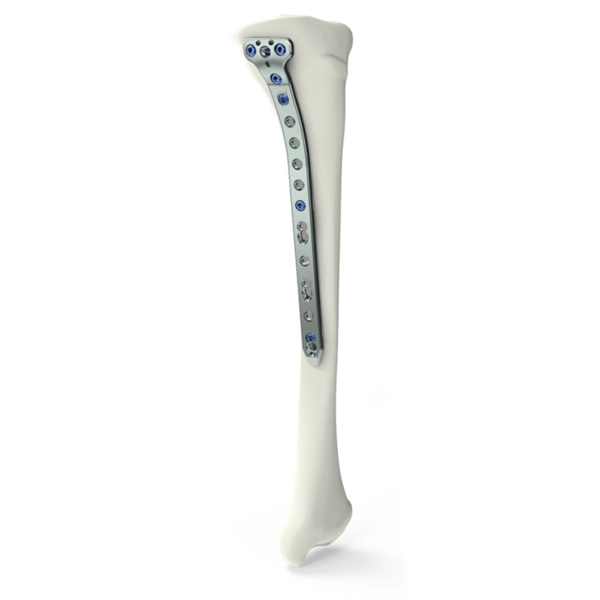 Pelat penguncian osteotomi tibialis medial proksimal