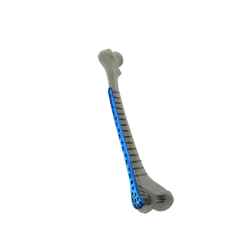 The Ultimate Guide to the Distal Femoral Locking Plate