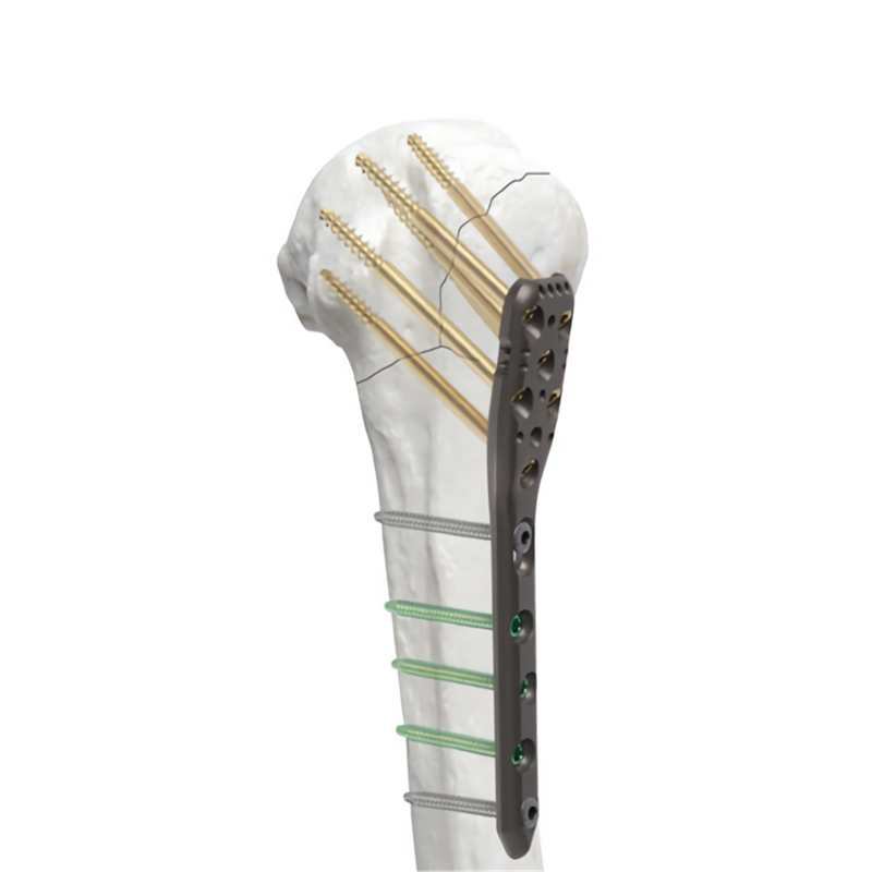 Proximal Humeral Locking Plate: Comprehensive Guide