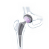 Sistem Hip Separa Tanpa Simen
