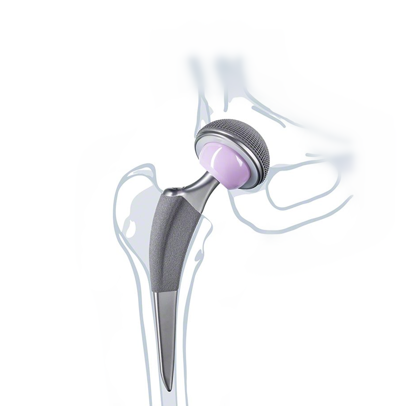 Sistem Hip Separa Tanpa Simen