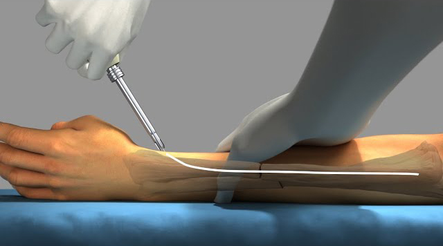 How to remove the intramedullary nail?
