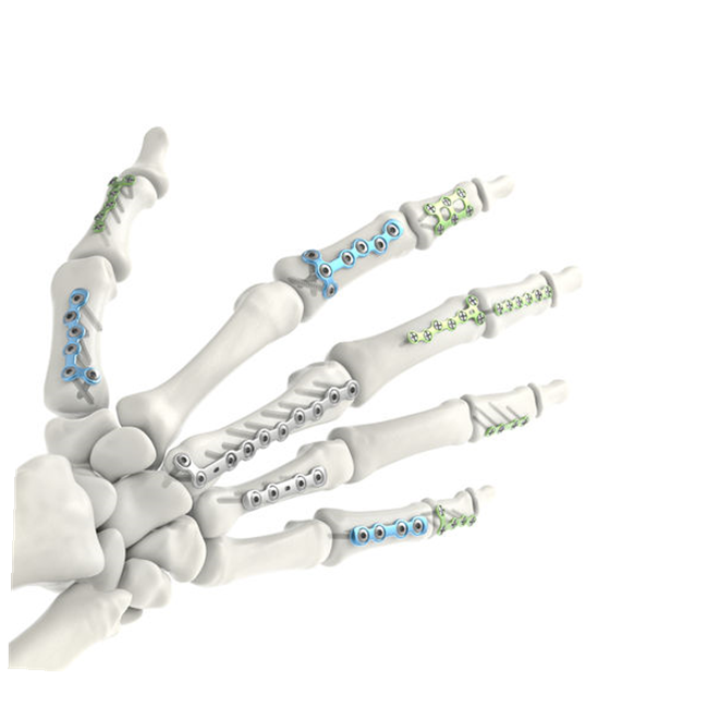 Metacarpal Locking Plates: Advances in Hand Fracture Treatment