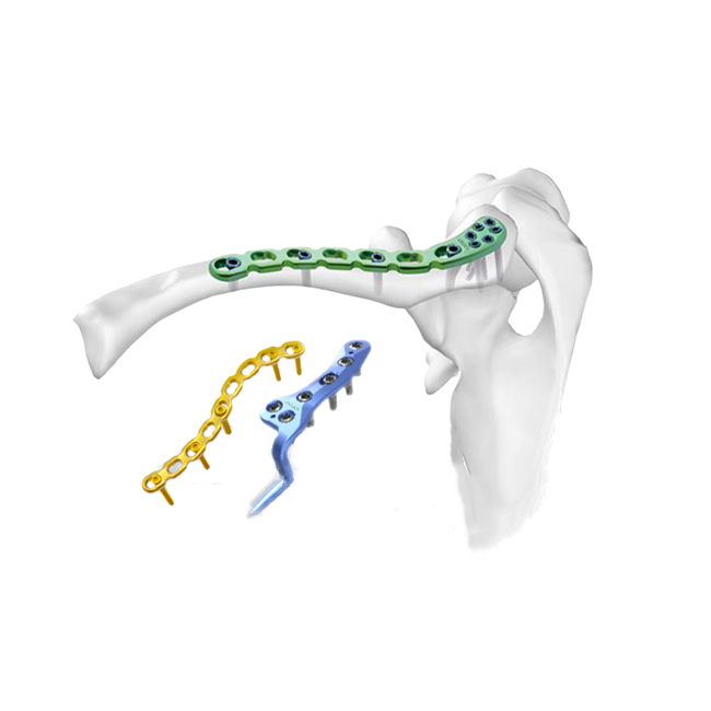 Clavicle Locking Plate: Enhancing Stability and Healing