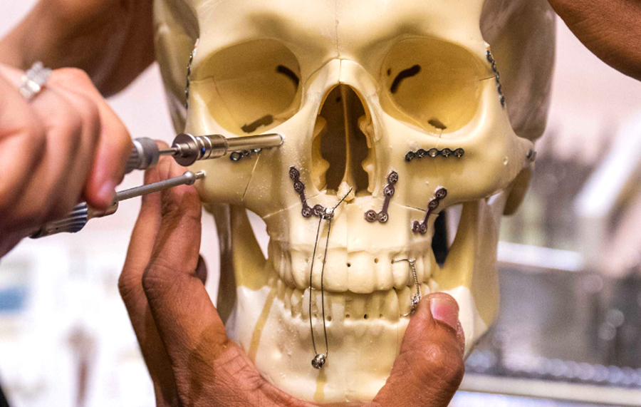 maxillofacial plates
