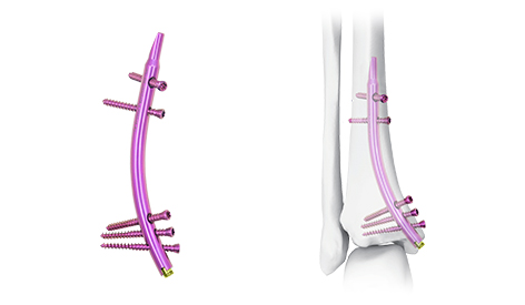 Kuku tibialis distal: Terobosan dalam pengobatan fraktur tibialis distal