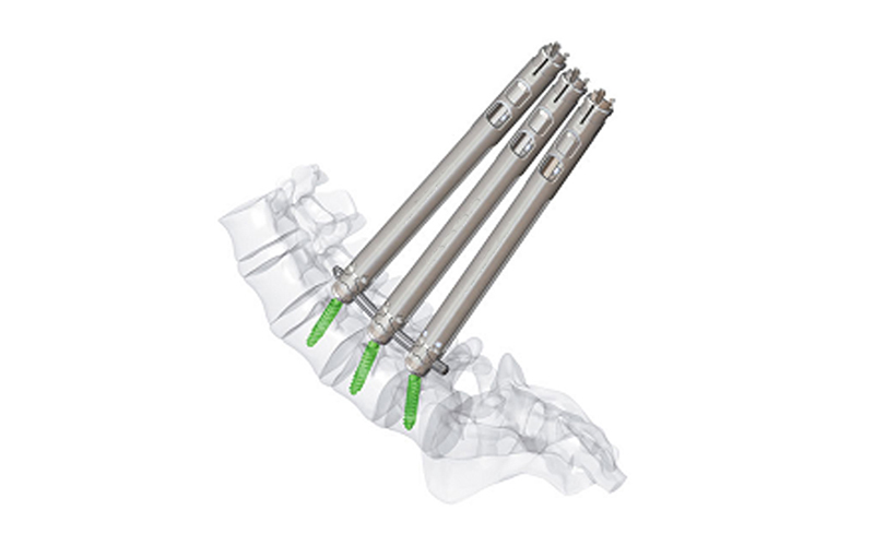 5.5-minimally-invasif-screw-screw