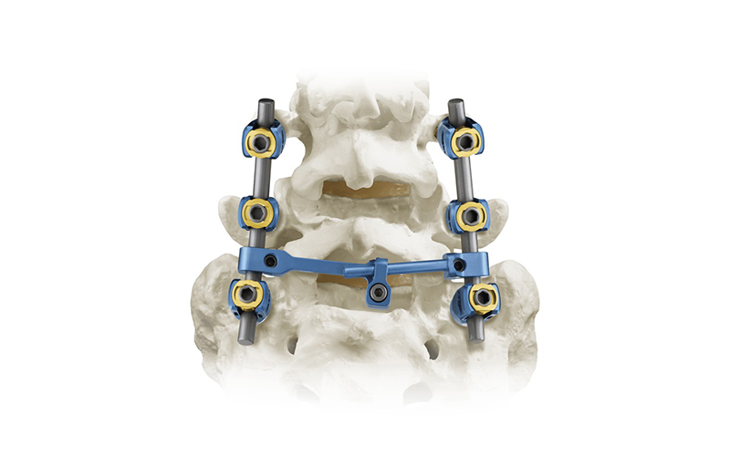 Sistem 5.5-spinal-pedikel-sprew