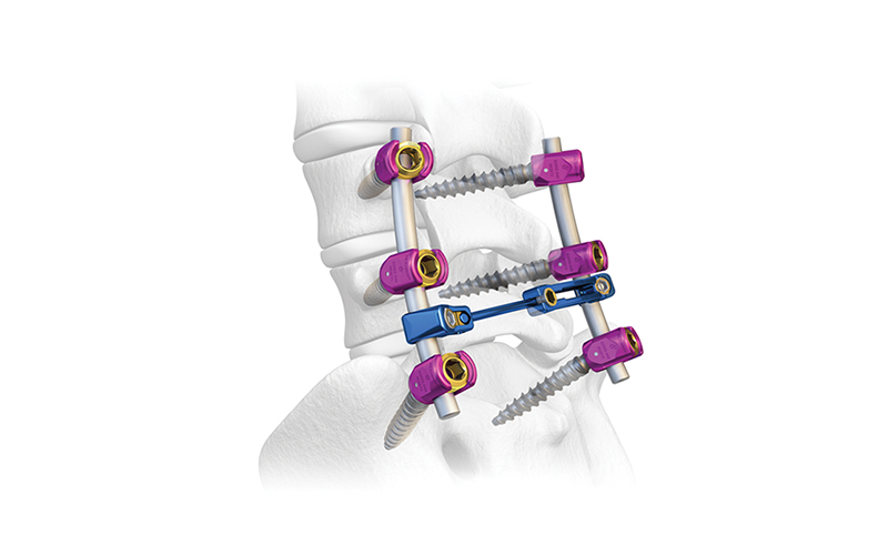 6.0-spinal-pedikel-sprew-sistem