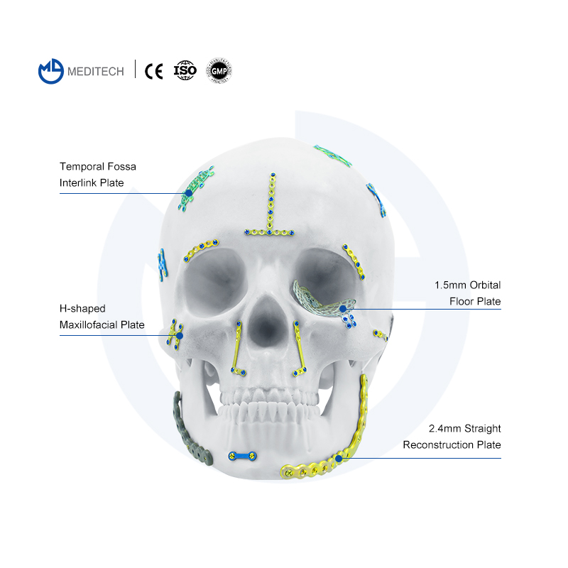 Maxillofacial Plate 1.5MM Self-drilling Screw