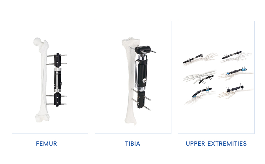 External Fixation Device