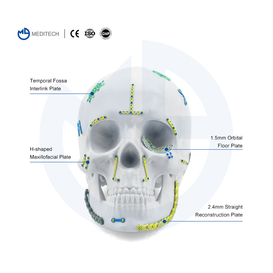 maxillofacial plates
