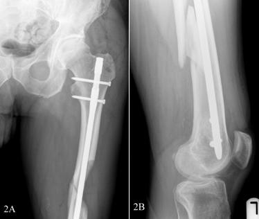 A-Anteroposterior-view-of-the-proximal-femur-with-the-intramedullary-nail-in-situ-B