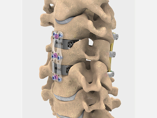 What are cervical implants?