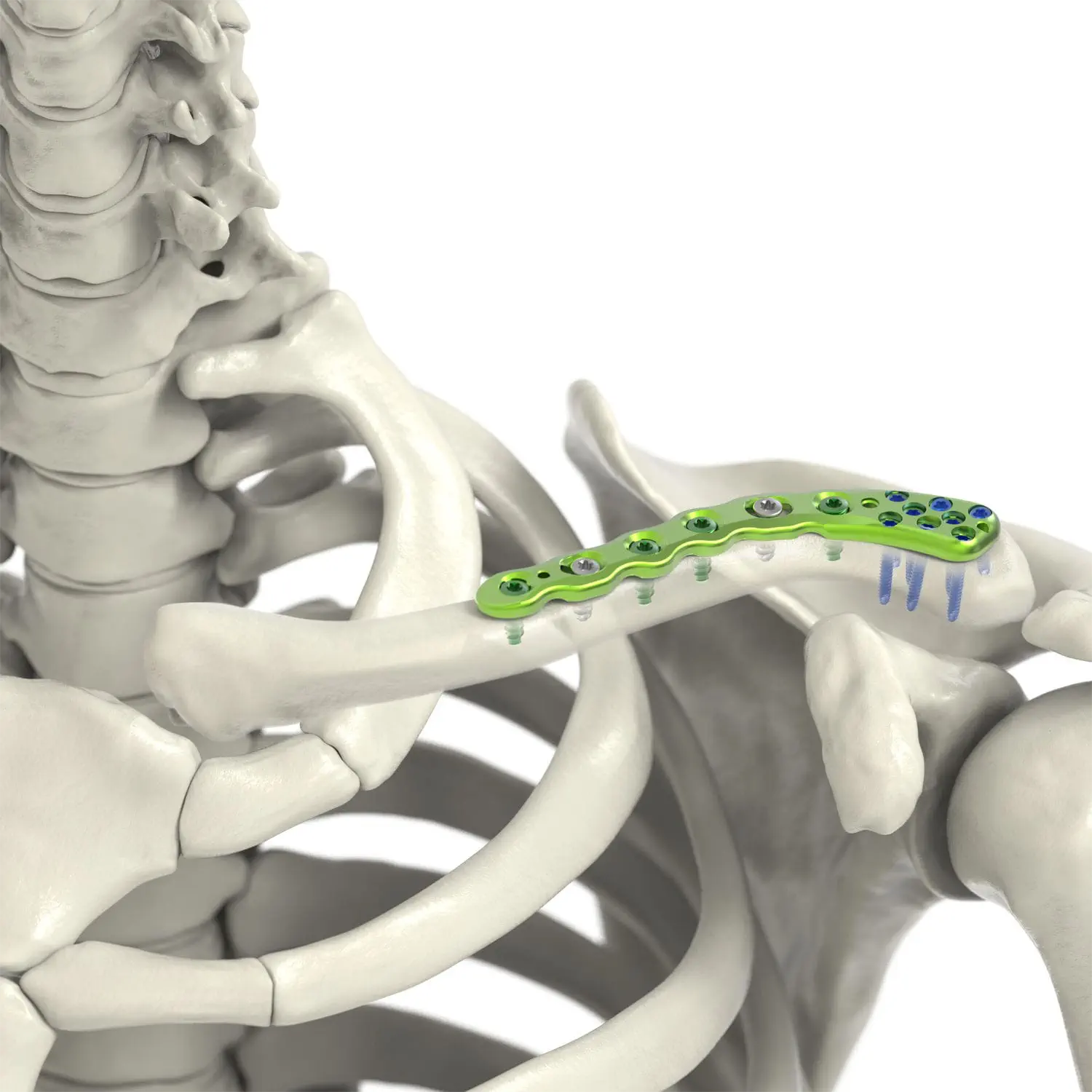 Clavicle Locking Plate: Enhancing Healing and Stability