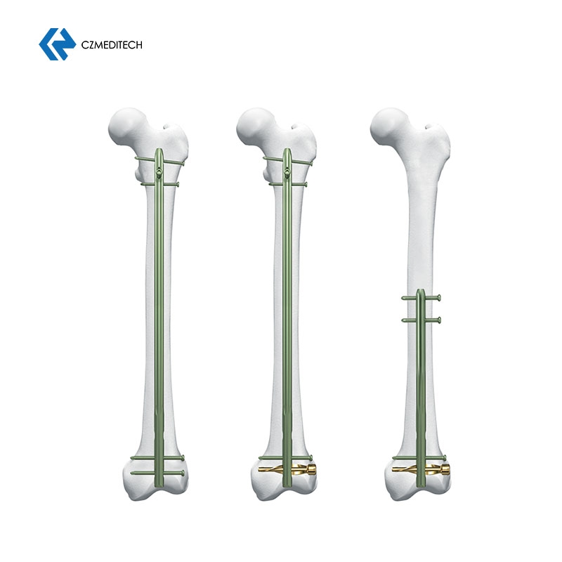 DFN Distal Femur Intramedullary Nail (4)