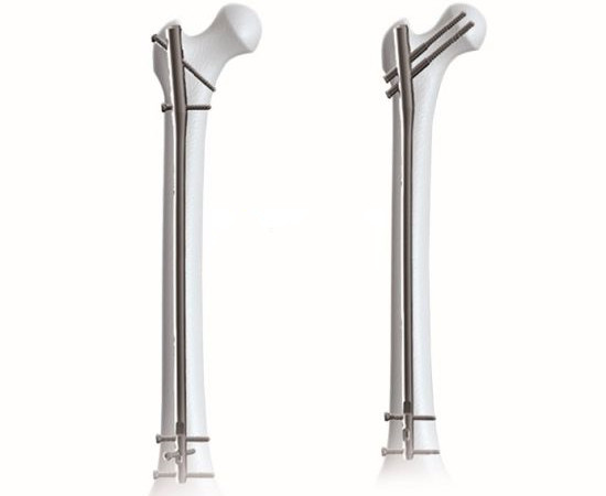 Expert Femoral Intramedullary Nail