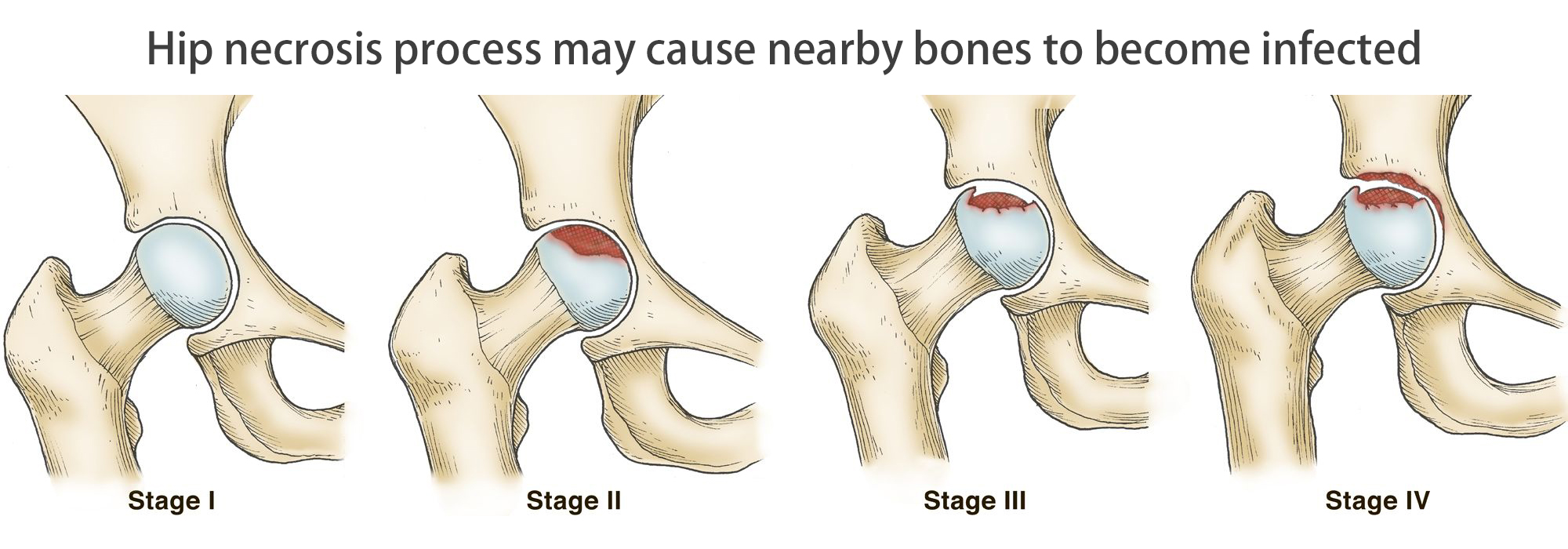 Hip necrosis process Hip necrosis process