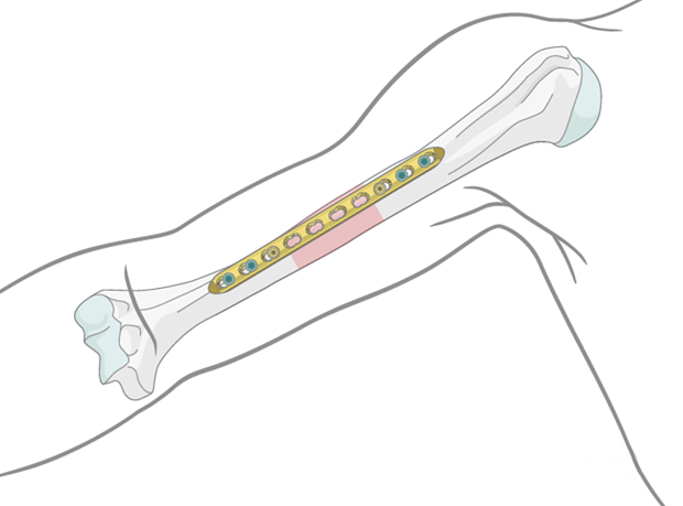 Humeral Shaft Locking Plate: A Modern Approach to Fracture Management