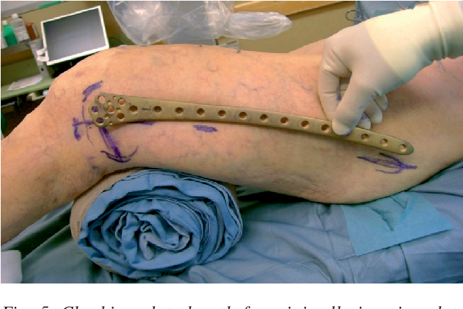 Locking Plate Surgery: An Advanced Approach to Bone Fracture Treatment