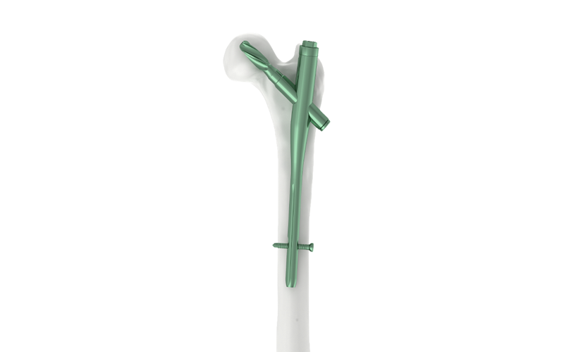 PFNA Nail: An Effective Orthopedic Solution