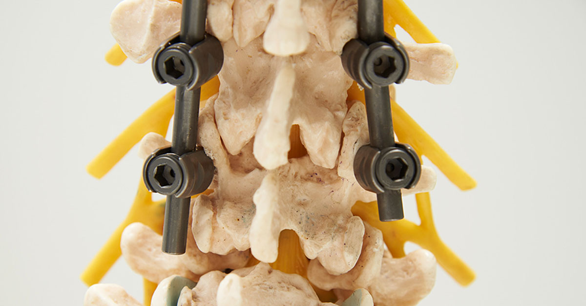 Percutaneous-Screws-Nuvasive-Precept.jpg