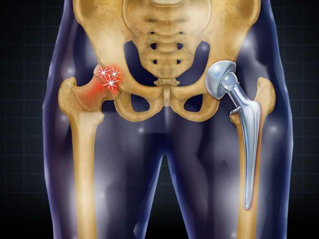 Scenarios for use of the femoral stem Scenarios for use of the femoral stem
