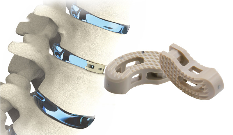 Implan Lumbar: Panduan Komprehensif