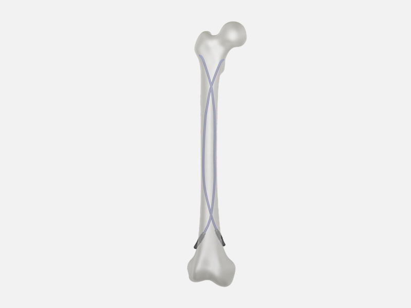 Titanium Elastic Nail: An Innovative Solution for Fracture Fixation