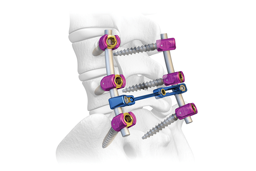 Apa-apa-spine-implan