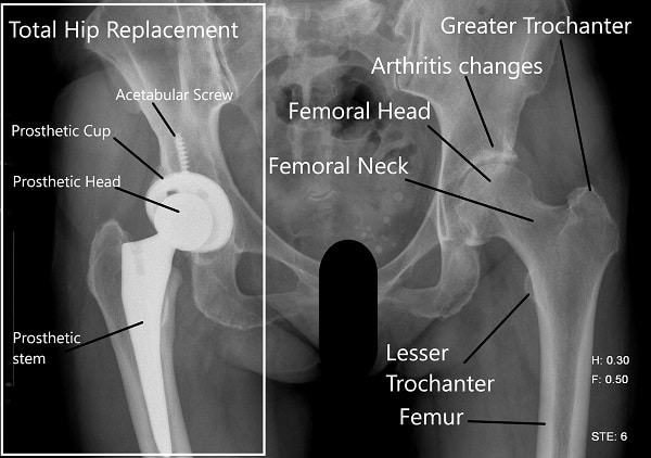 Where to use the femoral handle Where to use the femoral handle