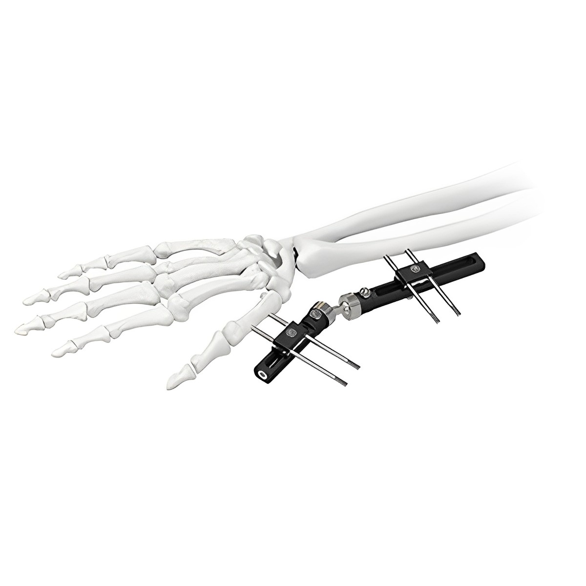 Fixator eksternal pergelangan tangan