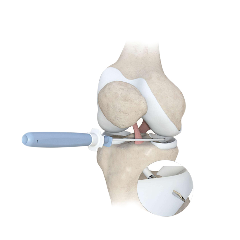 Sistem Perbaikan Meniscus