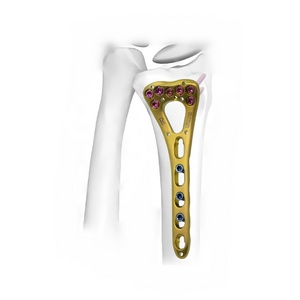 VA Distal Radius Locking Plate