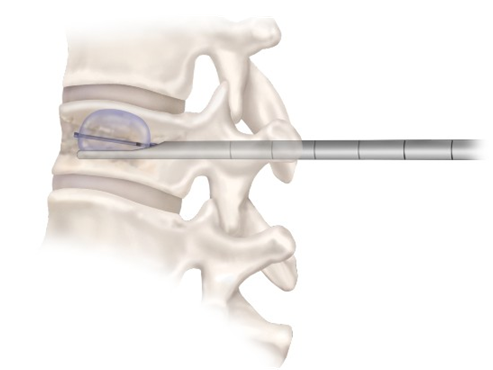 Kyphoplasty Balloon