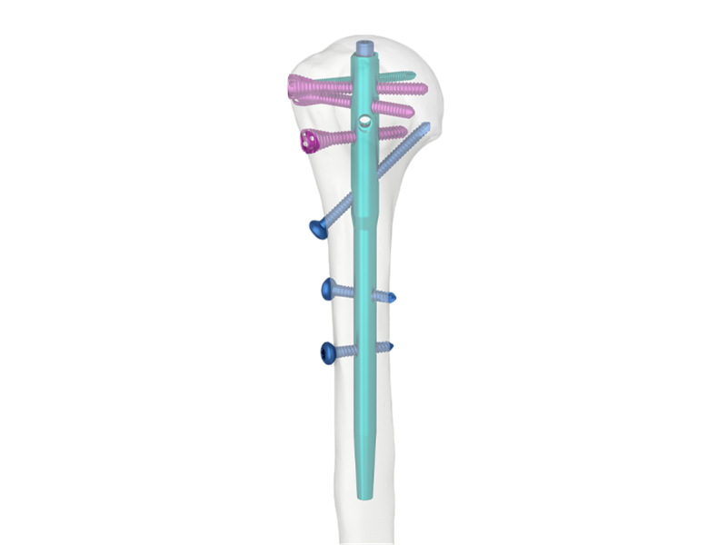 Multi-Lock Humeral Intramedullary Nail: Advancements in Shoulder Fracture Treatment