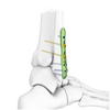 Distal Fibular Locking Plate