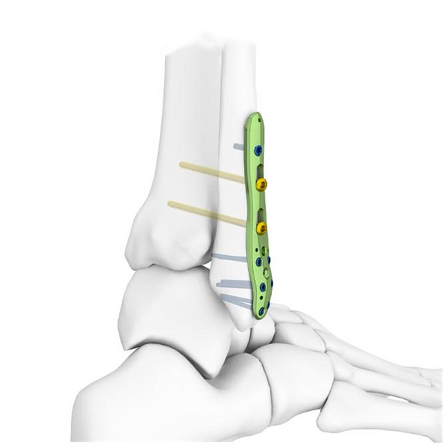 Pelat pengunci fibula distal