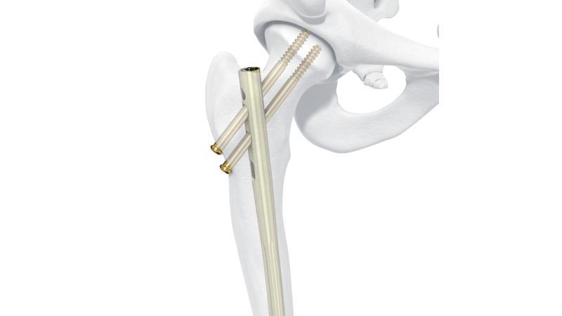 Femoral Reconstruction Intramedullary Nail