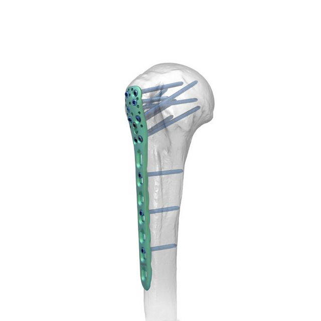 Pelat pengunci humerus proksimal