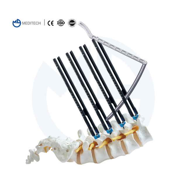 Sistem sekrup pedikel spinal mis (sistem 5.5mm)