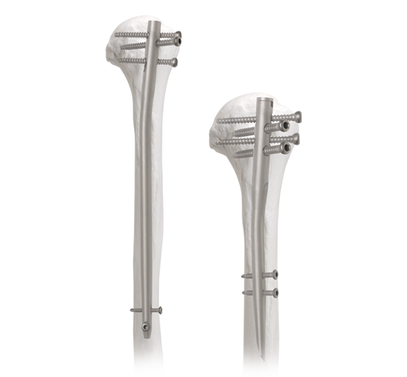 Humerus Intramedullary Nail: An Effective Solution for Treating Humeral Fractures