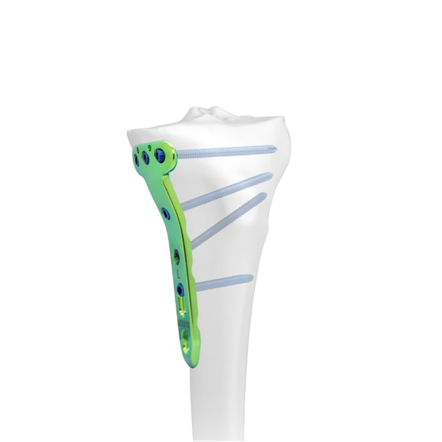 Pelat penguncian osteotomi tibialis medial proksimal