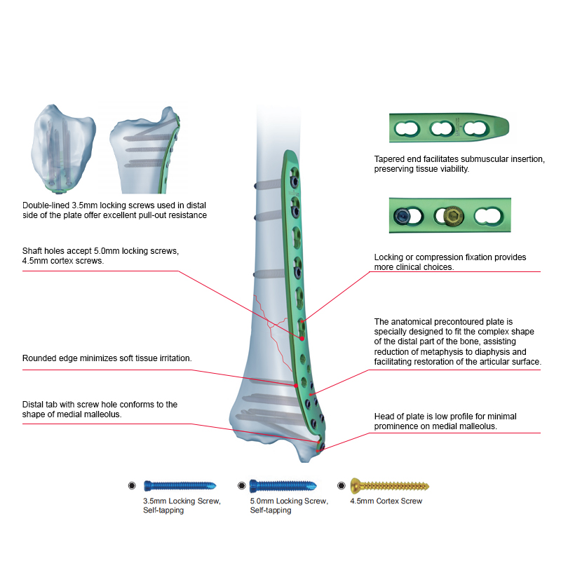Proximal Medial Tibial Locking Plate