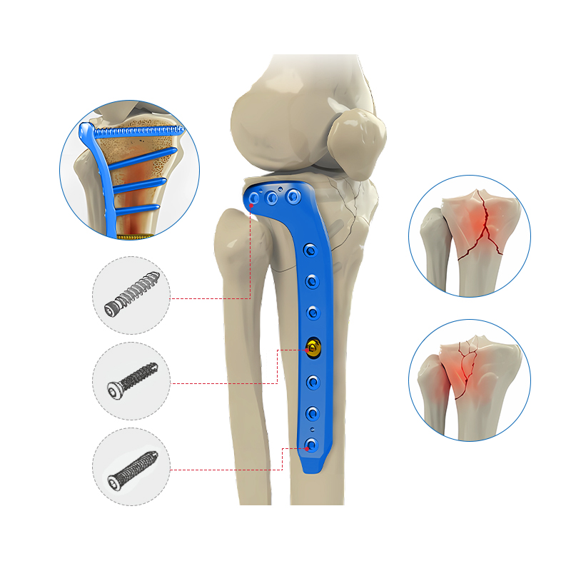 Proximal Medial Tibial Locking Plate