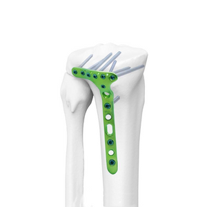 Distal Lateral Tibial Locking Plate-II