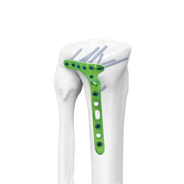 Pelat pengunci tibialis lateral distal-II