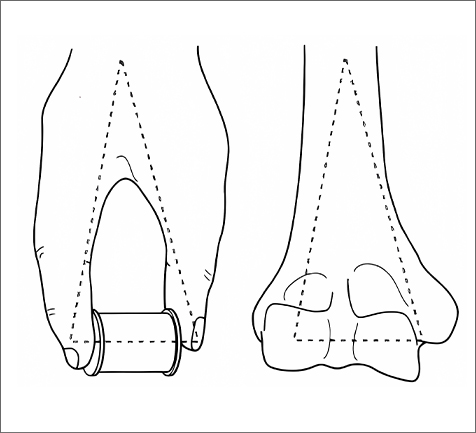 Piring pengunci humerus