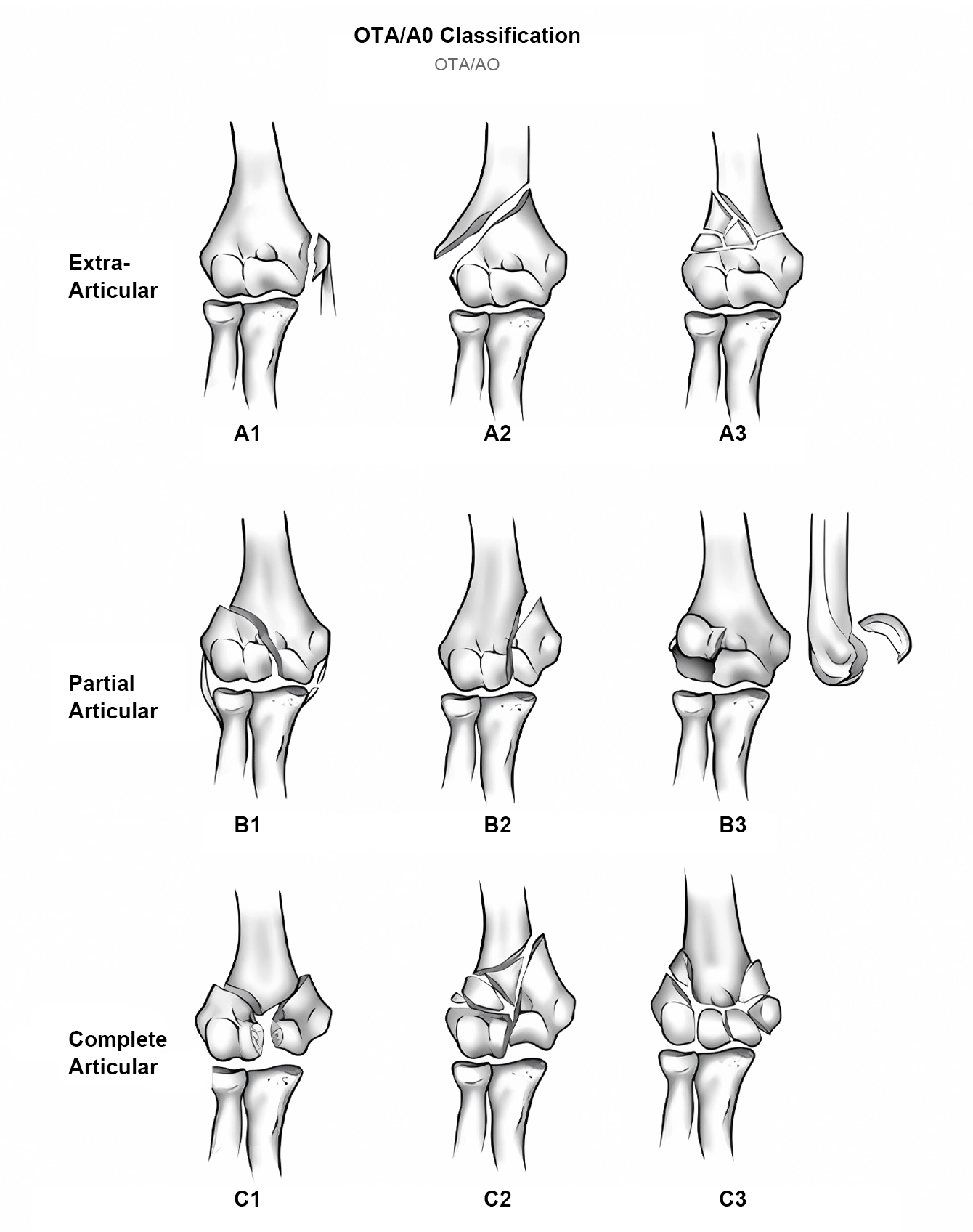 Piring pengunci humerus
